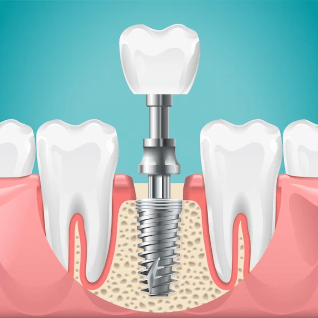 Implantes Dentário Garanhuns